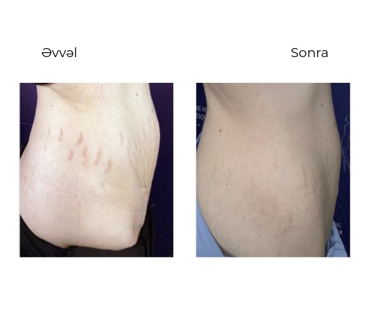 Candela Nordlys Mini